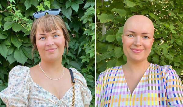 Anettes hårtabsrejse - alopecia