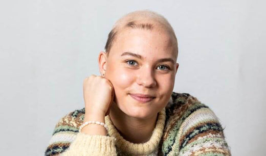 Nanna fortæller åbent om det at have alopecia