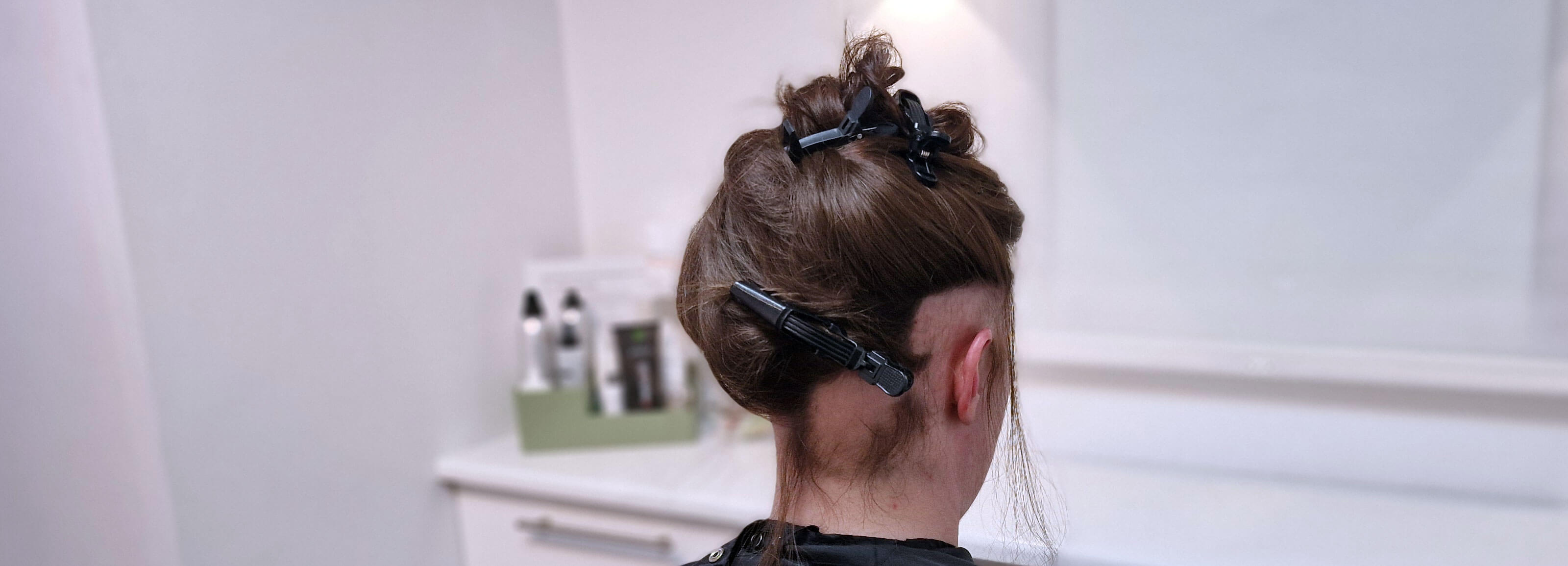 Billede af ung kvinde med alopecia areata, hvor hun mangler hår i nakken og over øret.