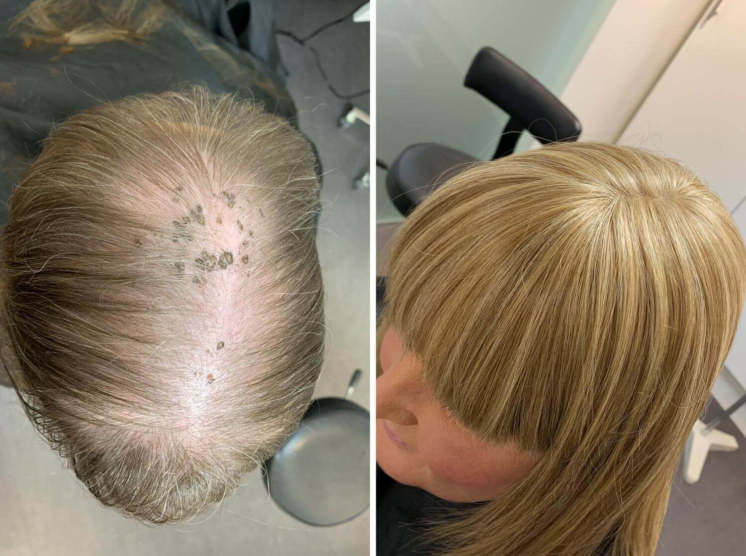 Før og efter billede af en kvinde med alopecia. I dette tilfælde er hun blevet meget tyndhåret.