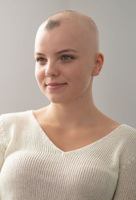 Kvinde med alopecia der har tabt alt sit hår