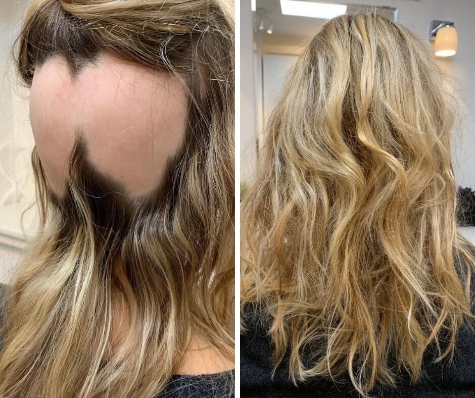 Her er et før og efter billede af en ung kvinde med alopecia, der har givet hende pletskaldethed.