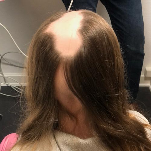 Pletskaldethed også kaldet alopecia areata, giver dit mindre eller større plamager uden hår. Vi kan hjælpe dig hos Toftild.