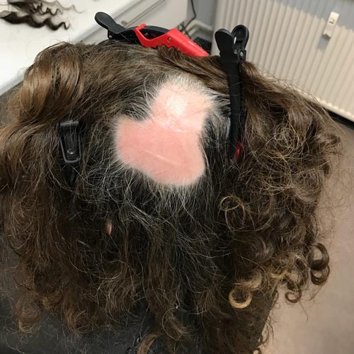 Her ses en kvinde med alopecia areata, også kaldet pletskaldethed. Hos Toftild hjælper vi hende med at dække de bare pletter, så omverdenen ikke kan se de bare pletter.