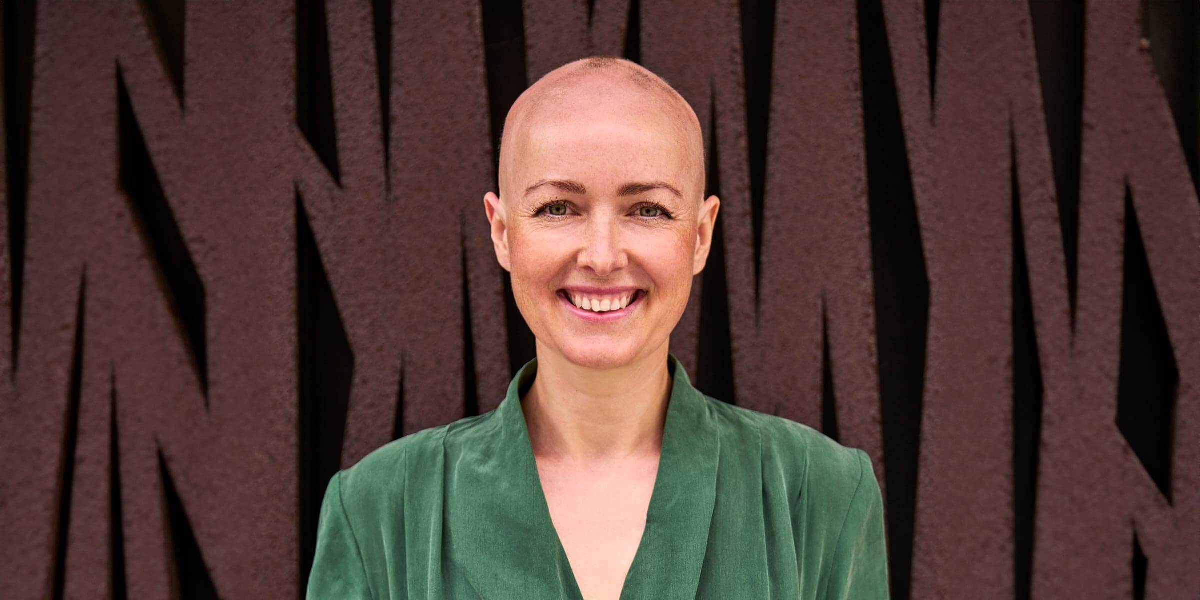 Smukke Aja uden hår. Hun har alopecia, og har ikke meget hår på hovedet.