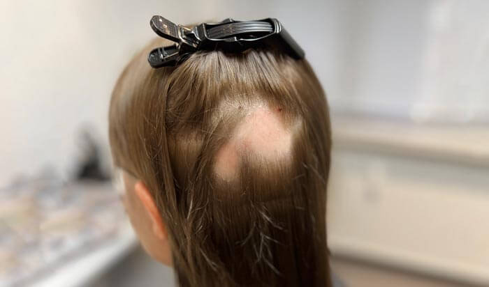 Pletskaldethed er et pletvist hårtab der kan ramme både kvinder og mænd i alle aldre