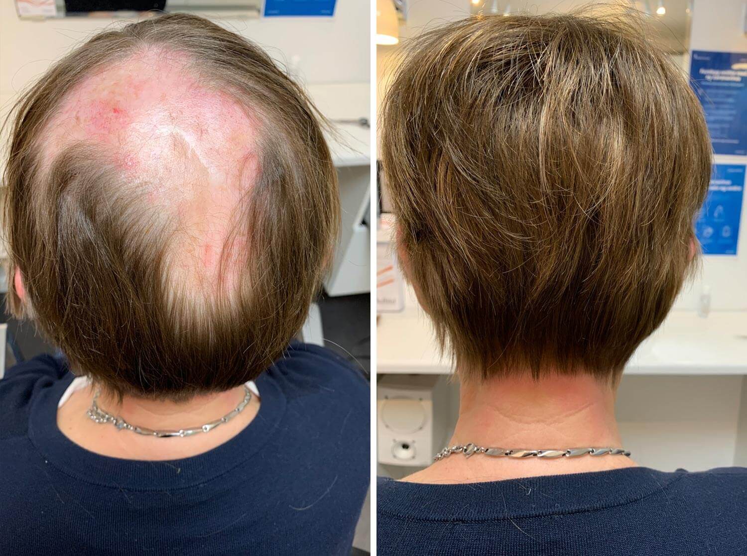 Et før og efter billede af en kvinde med alopecia, der giver pletvis hårtab på hovedet.