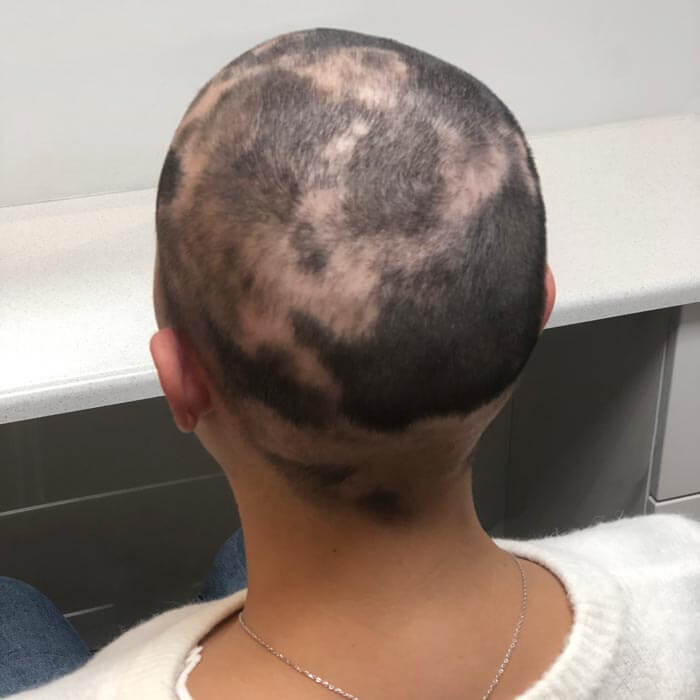 Alopecia Areata er en sygdom der gør, at du bliver pletskaldet. Vi kan hjælpe dig her hos Toftild.