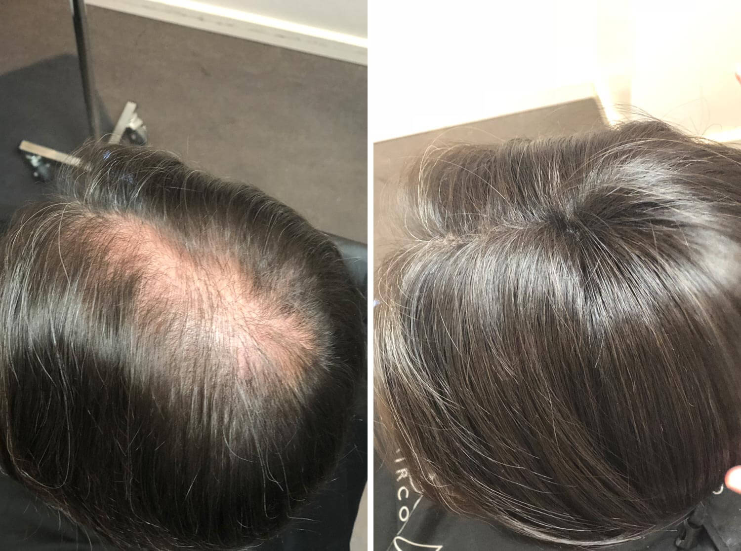 Før- og efter billede af en kvinde der har fået påsat en hair topper