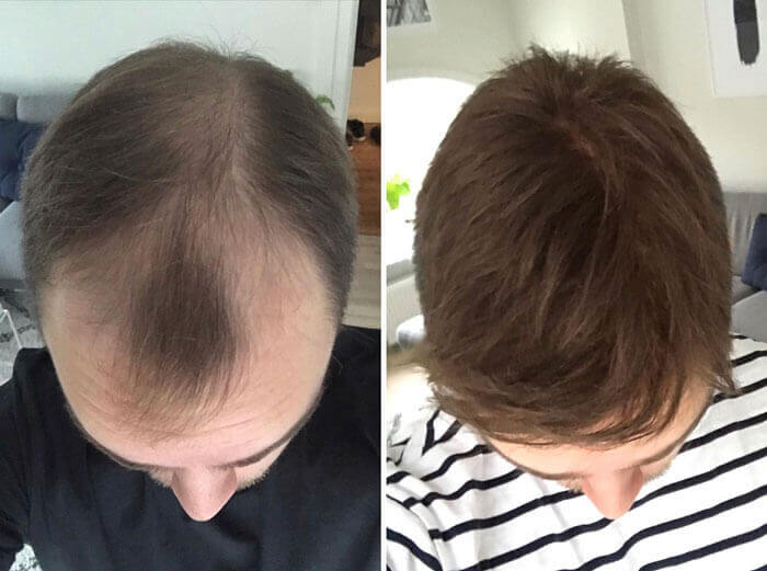 Før- og efter billeder af en herre der har fået påsat toupe fra Toftild Alternativt Hår