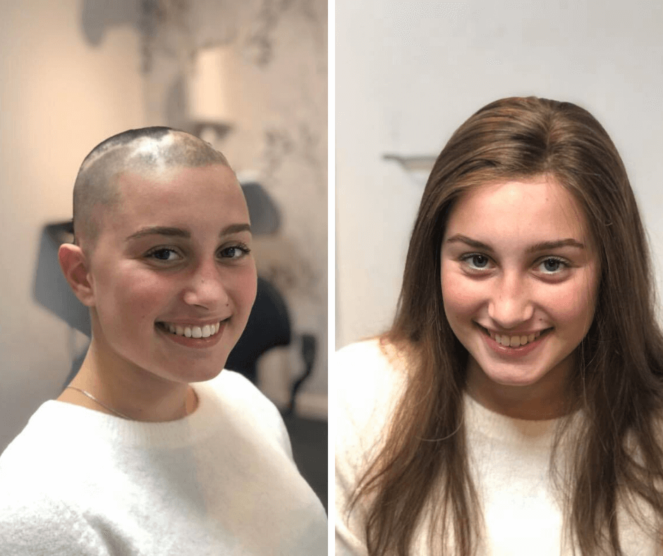Malou har alopecia og har fået hjælpe til håret hos Toftild Aalborg. Du kan booke din gratis konsultation
